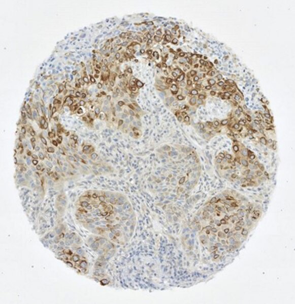 IHC of lung cancer cells labeled with DSHB antibody CPTC-AKT3-2 against AKT Serine/Threonine Kinase 3 Peptide 4. Image Credit: NCI-Clinical Proteomic Technologies for Cancer.
